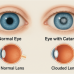 Graphic of eyes with Cataract before and after surgery